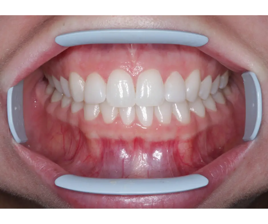 Patient's smile after buccal corridor correction showing wider, fuller smile with eliminated dark spaces