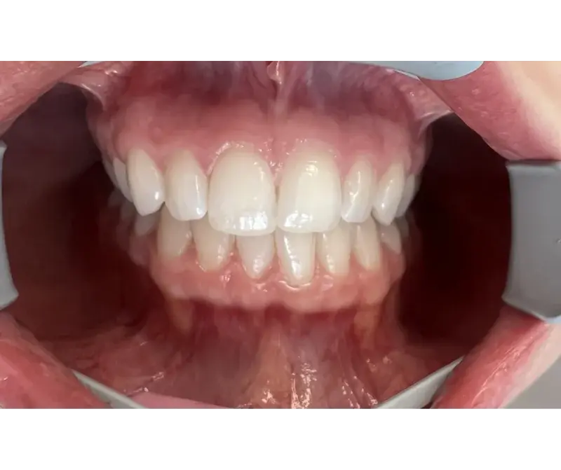 Before buccal corridor correction treatment