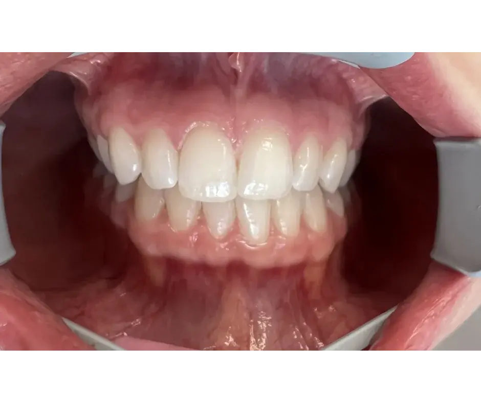 Before orthodontic treatment - buccal corridor correction