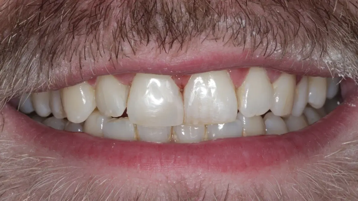 After airflow stain removal and polished composite bonds