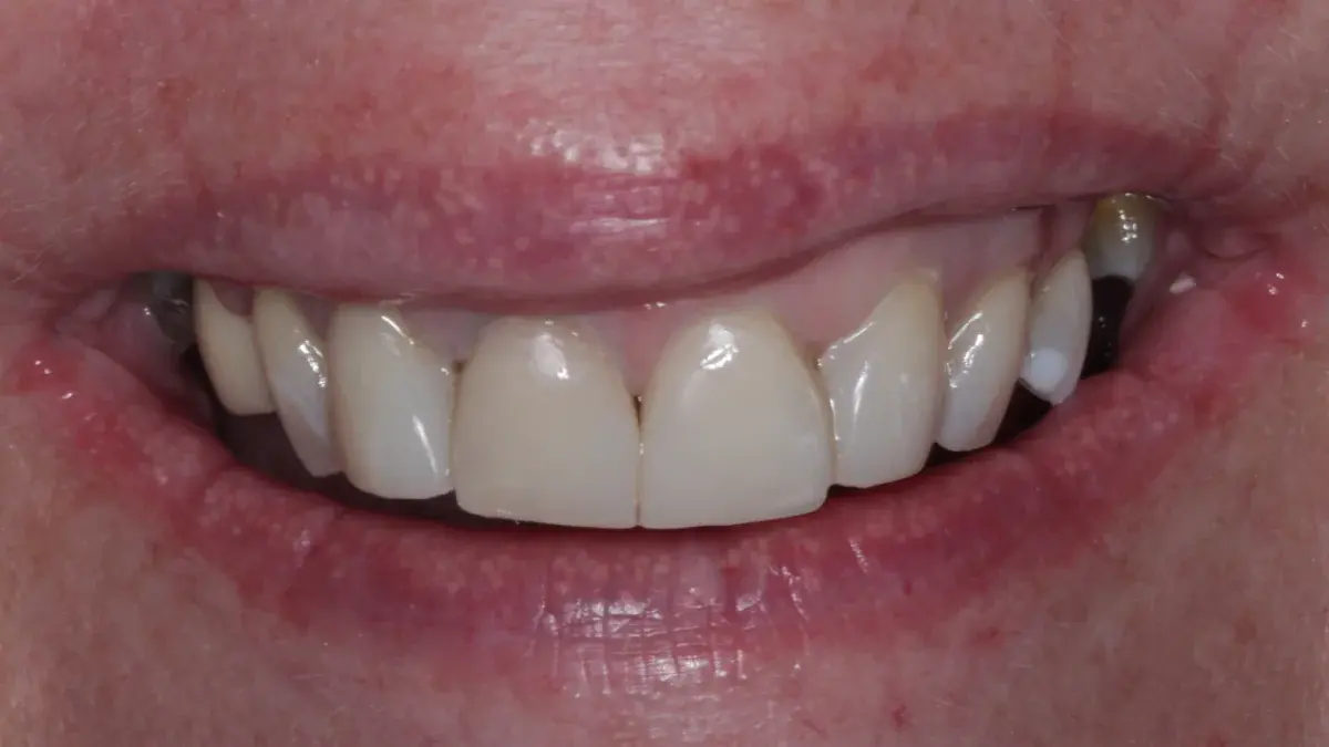 After composite bonding with improved edge contour