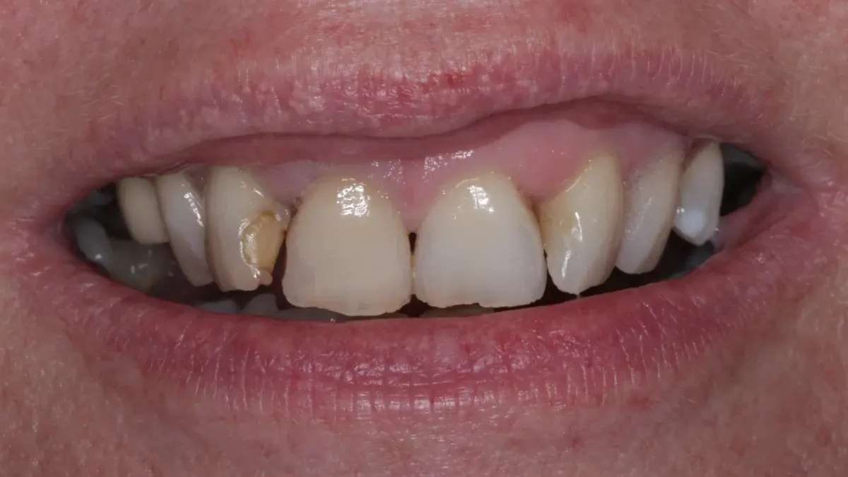 Before composite bonding