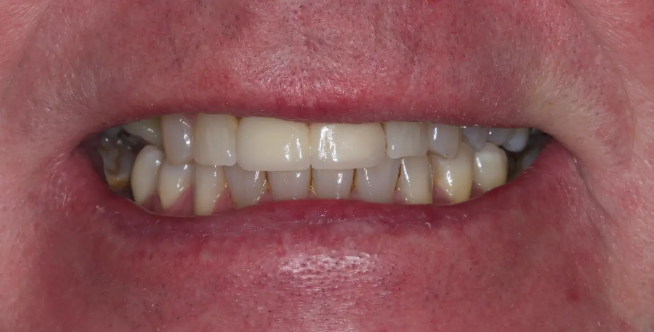 Patient after flexible denture treatment with natural-looking, comfortable dentures providing full smile restoration