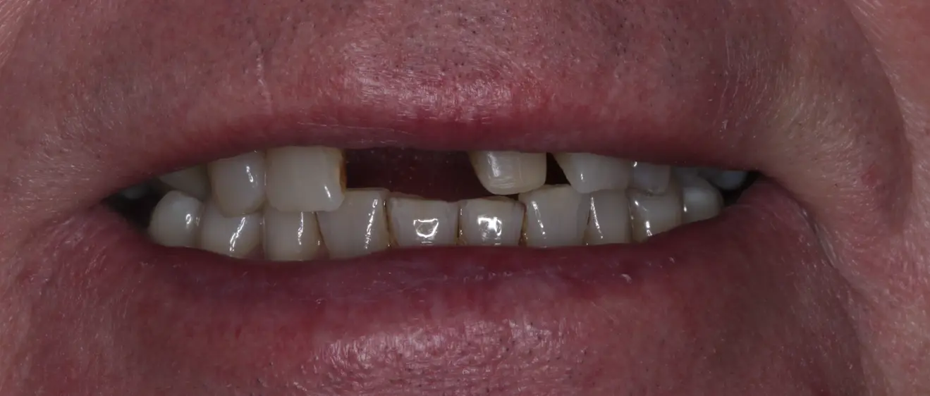 Patient before flexible denture treatment showing missing teeth and compromised smile