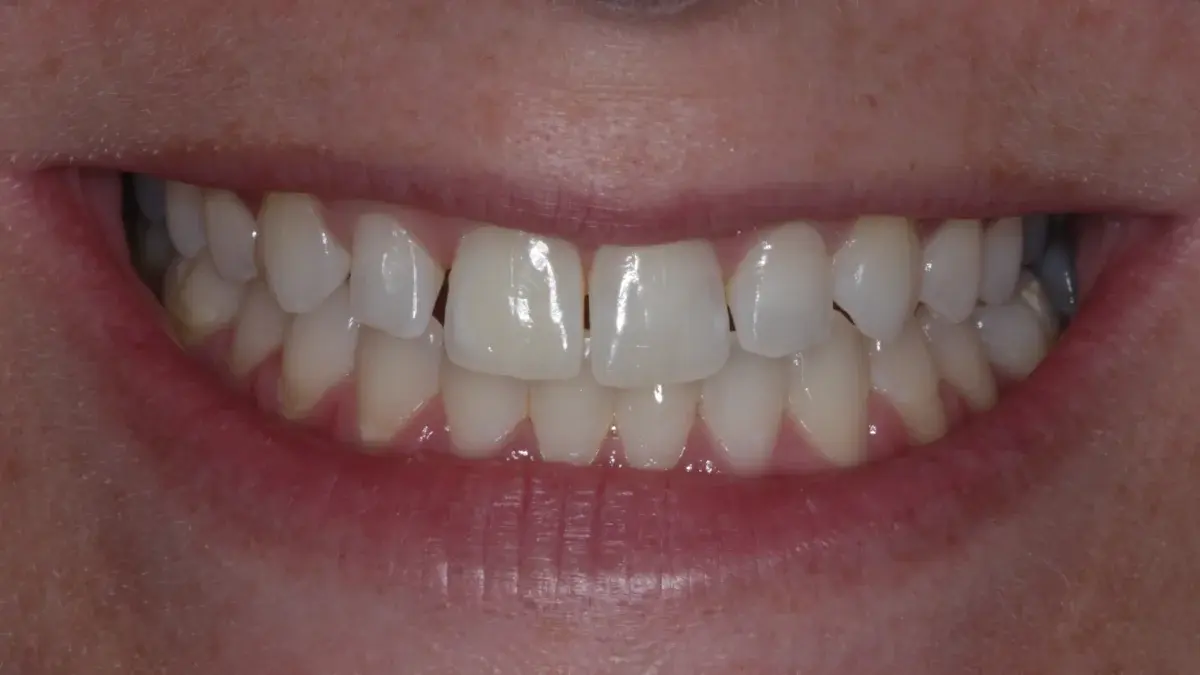 Patient after ClearCorrect orthodontic treatment showing improved alignment
