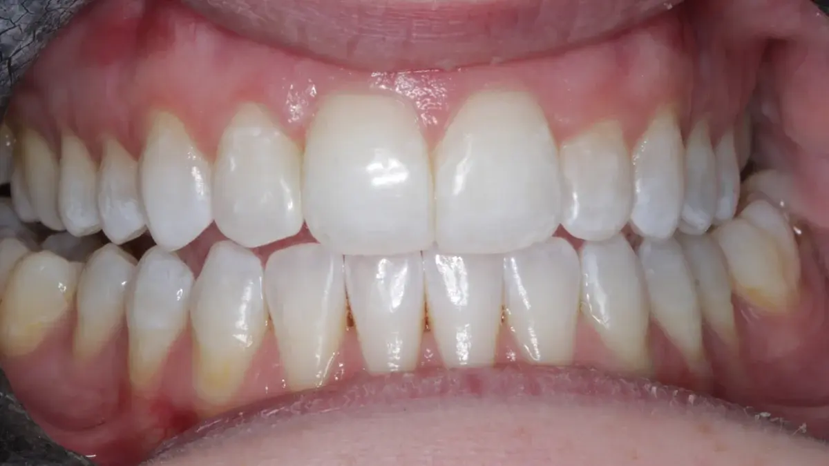 After Invisalign and Enlighten whitening with brighter alignment