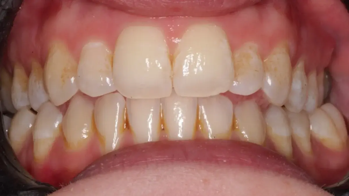 Before Invisalign and Enlighten whitening