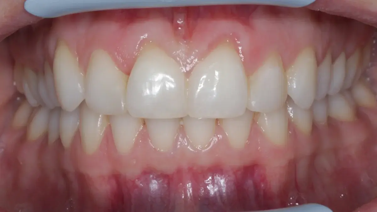 Patient's teeth after comprehensive orthodontic treatment - perfectly aligned, bright white smile with refined bonding