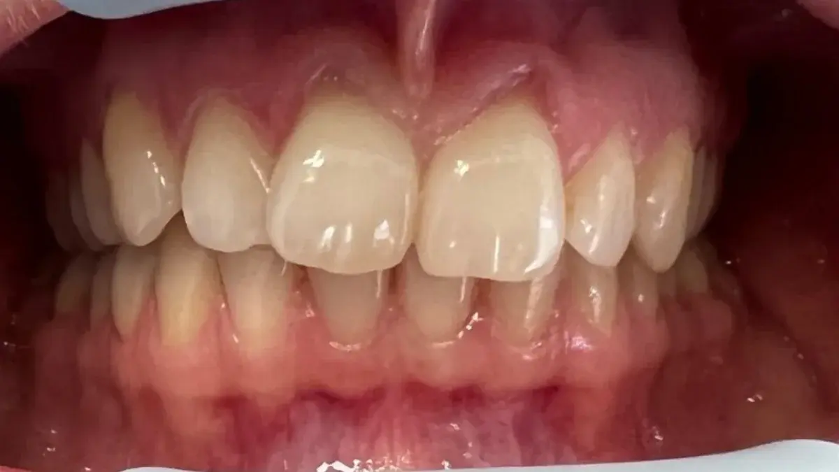 Patient's teeth before comprehensive orthodontic treatment including Invisalign, whitening and composite bonding