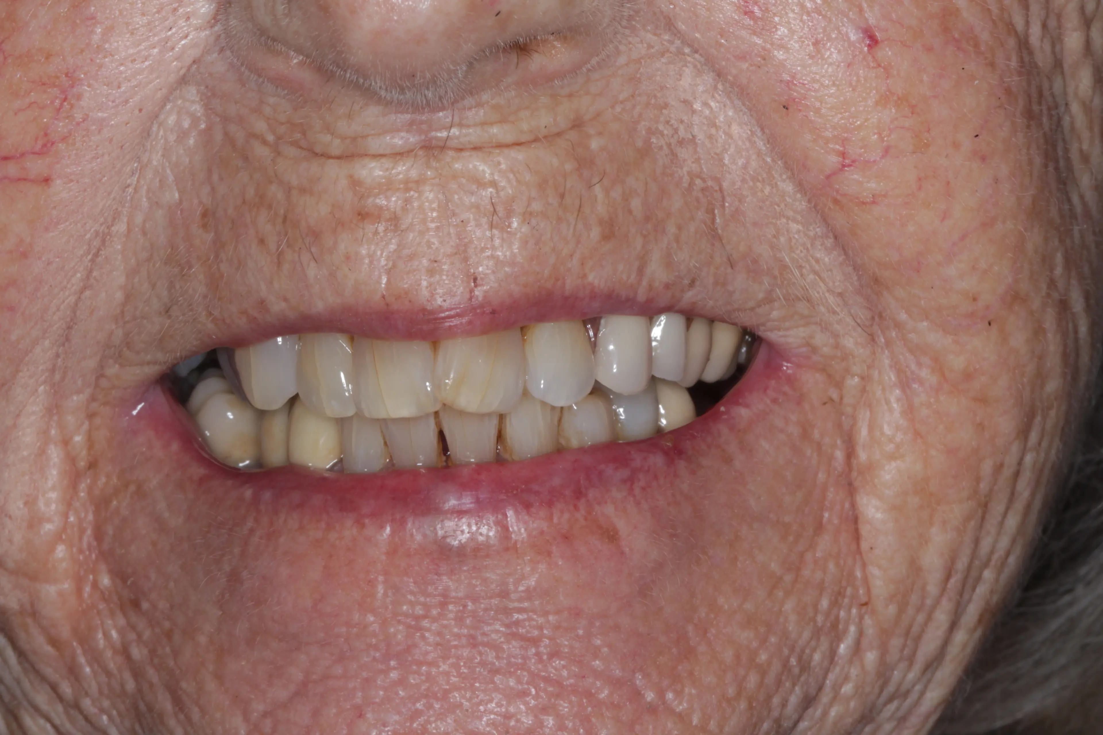 Patient after dental implant treatment with natural-looking replacement tooth perfectly integrated