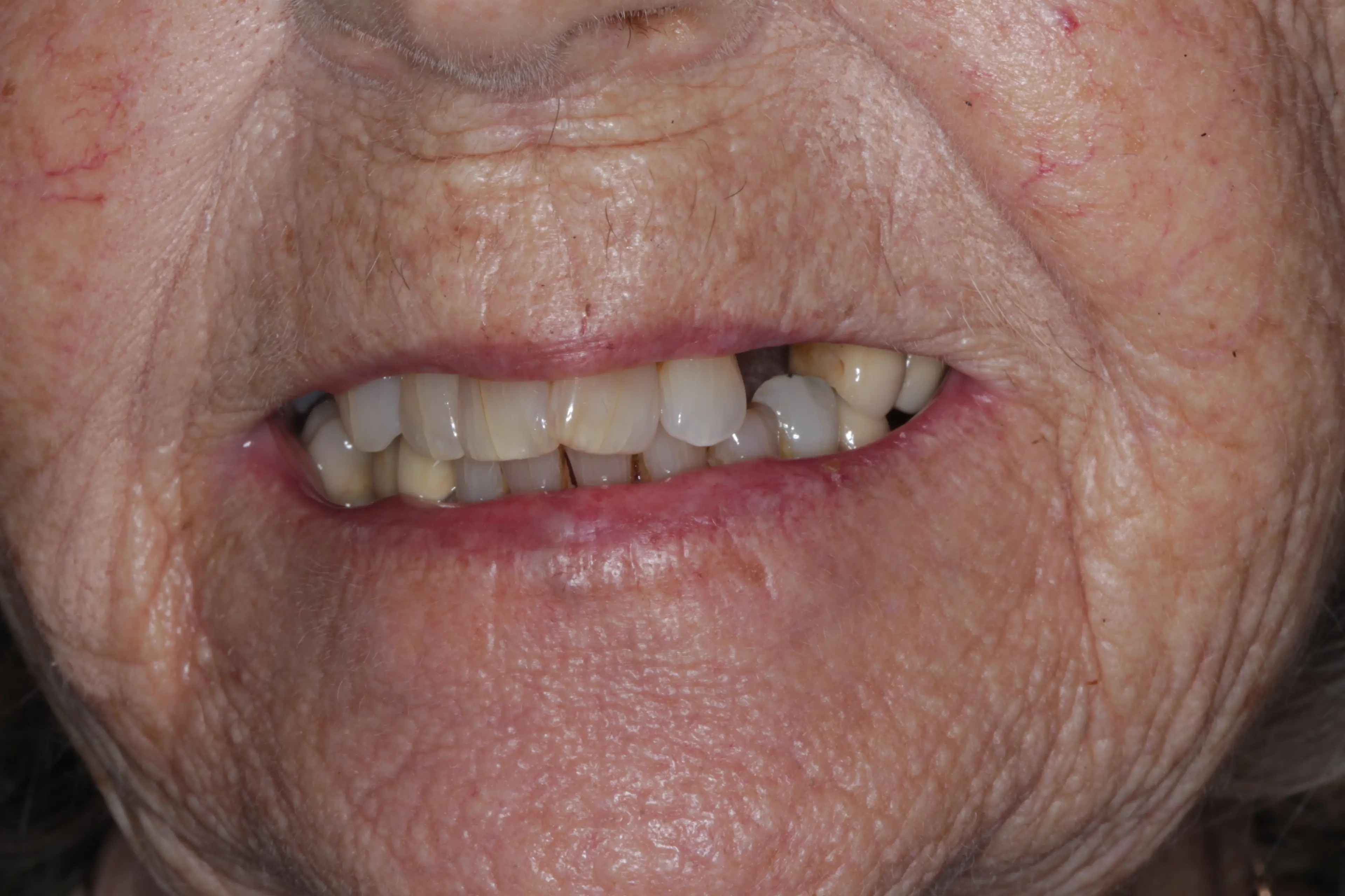 Patient with missing tooth before dental implant treatment showing gap in smile