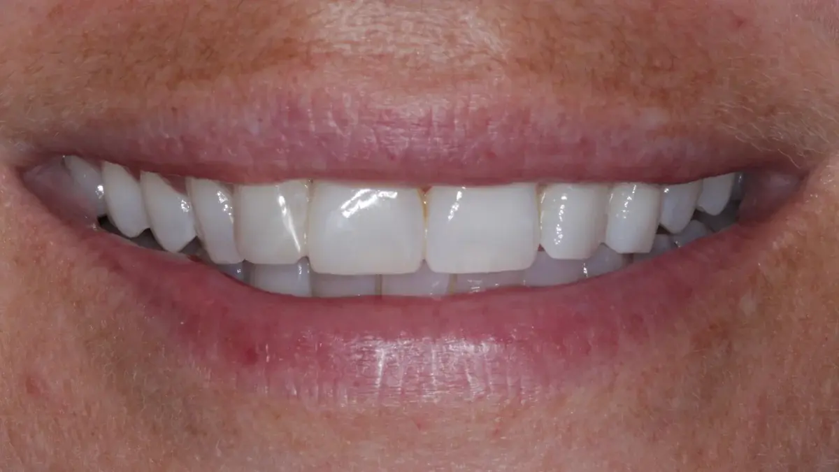 Patient's teeth after Enlighten whitening and composite edge bonding - brilliant white B1 shade with perfect edge alignment