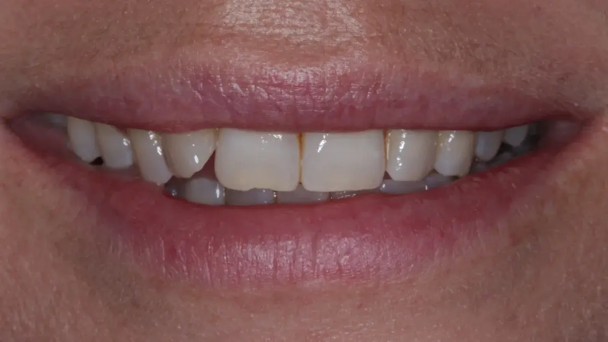 Patient's teeth before Enlighten whitening and composite edge bonding showing discoloration and minor imperfections