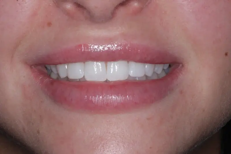 Buccal corridor correction - enhanced smile result
