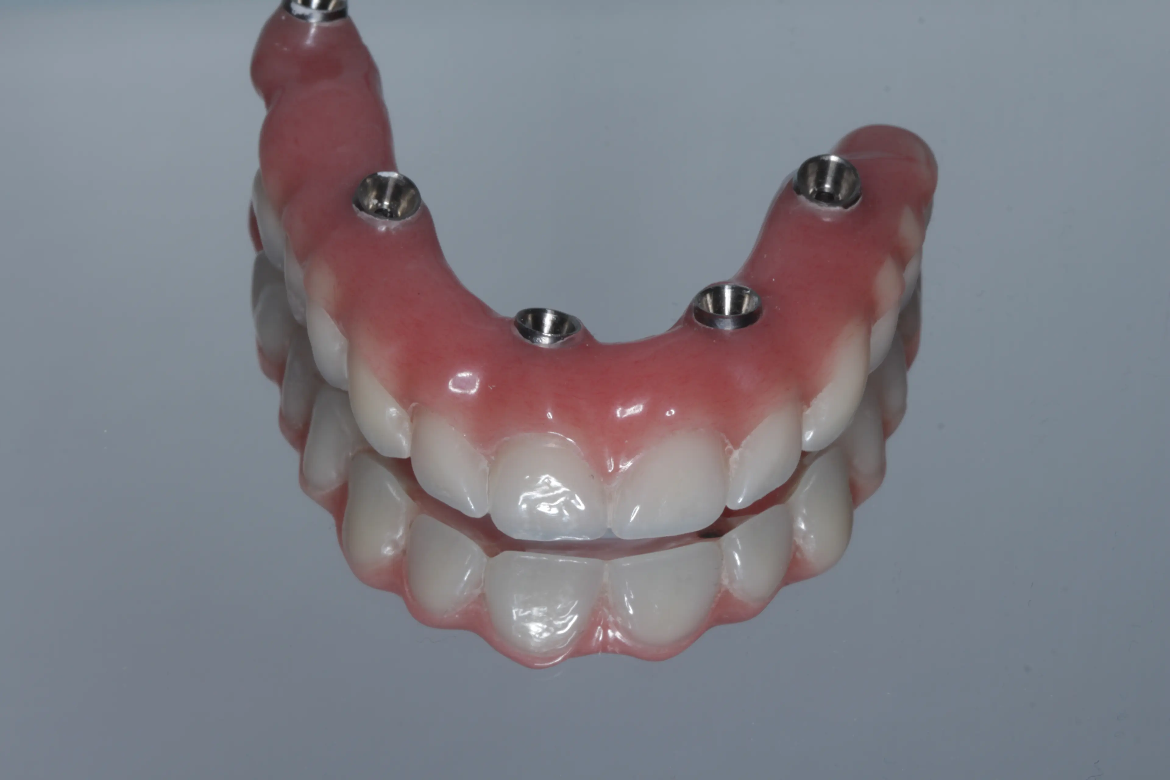 All-on-4 dental implants full arch restoration