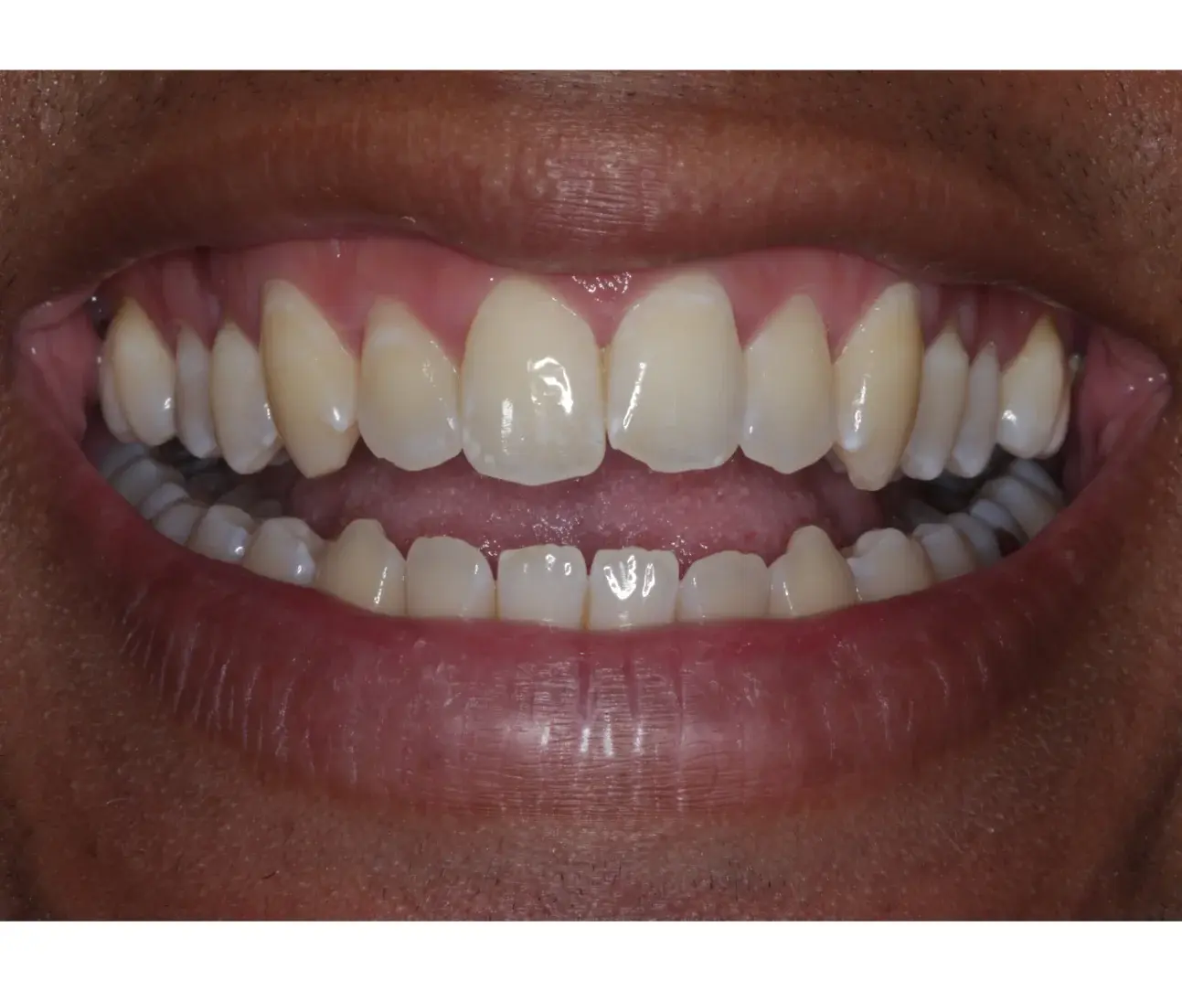 Smile before professional treatment at Pear Tree Dental