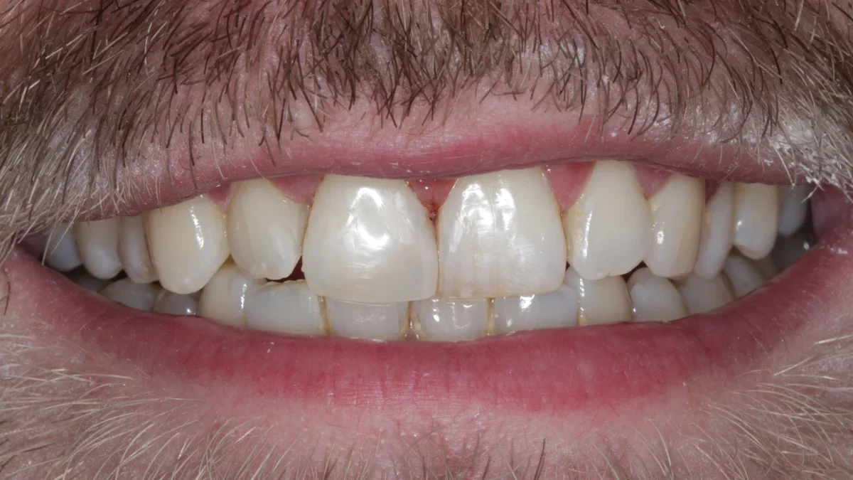Patient's teeth after airflow polish and composite bonding showing natural, restored appearance