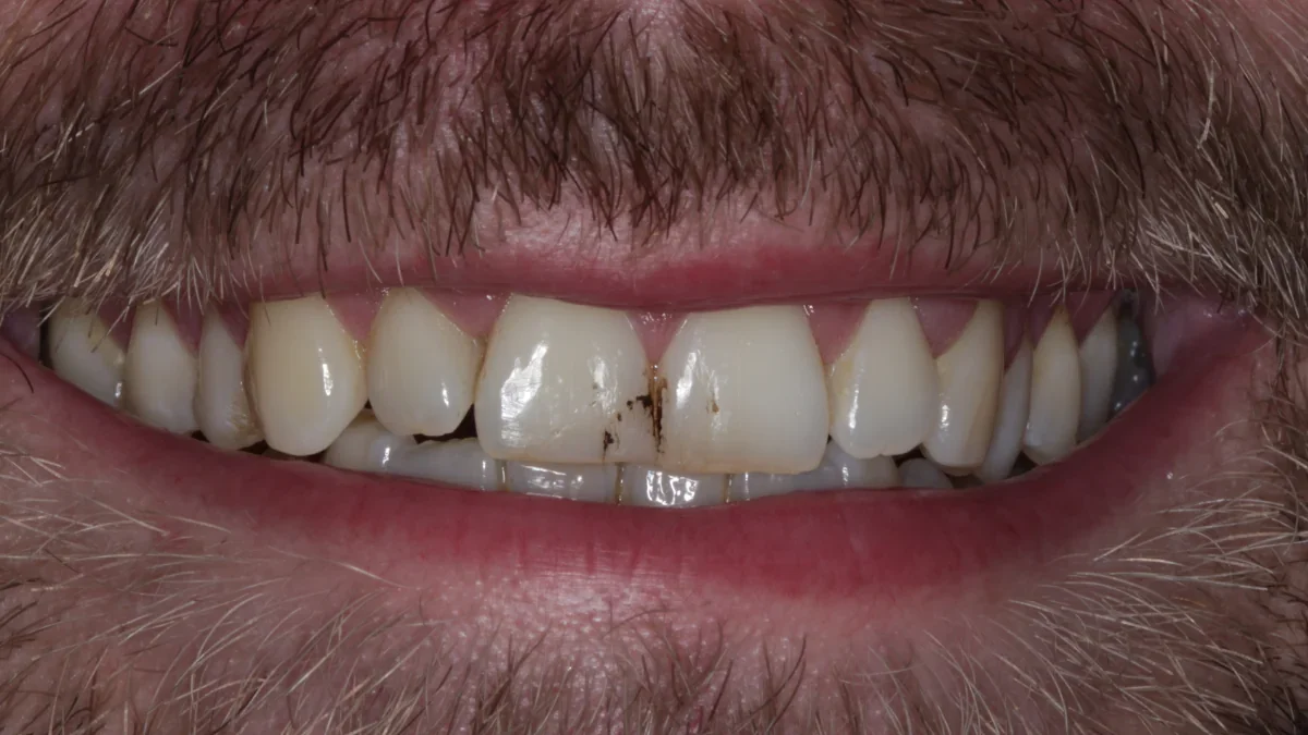 Patient's teeth before composite bonding treatment showing worn and discolored areas