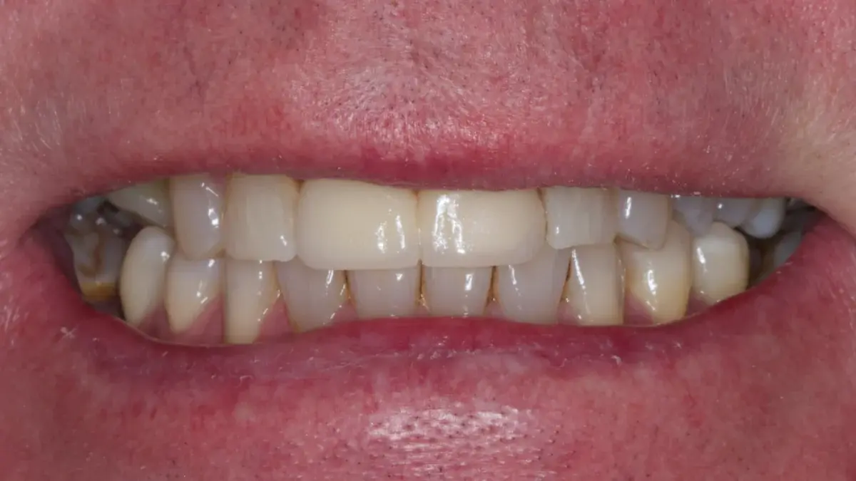 After dental bridge - natural-looking tooth replacement