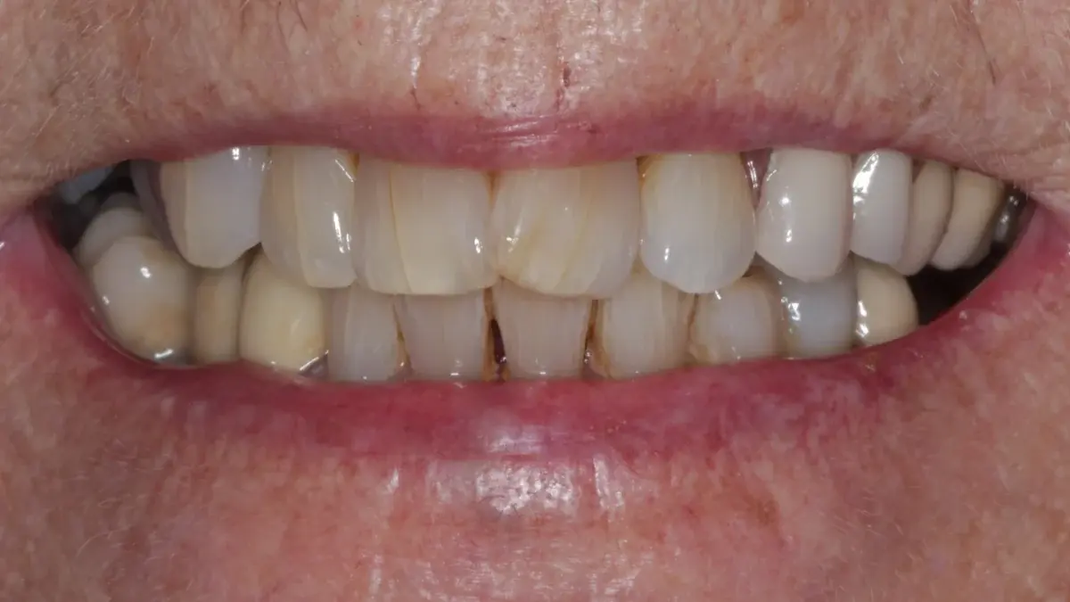 Patient's restored smile with natural-looking dentures providing full function