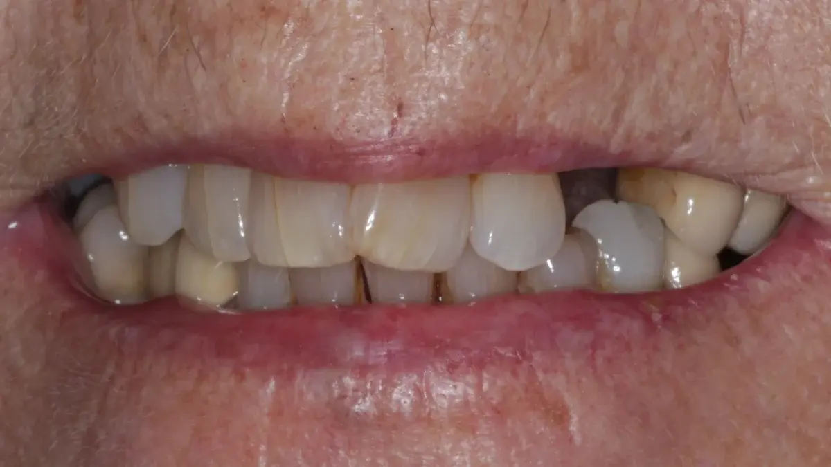Patient with missing teeth requiring denture replacement treatment