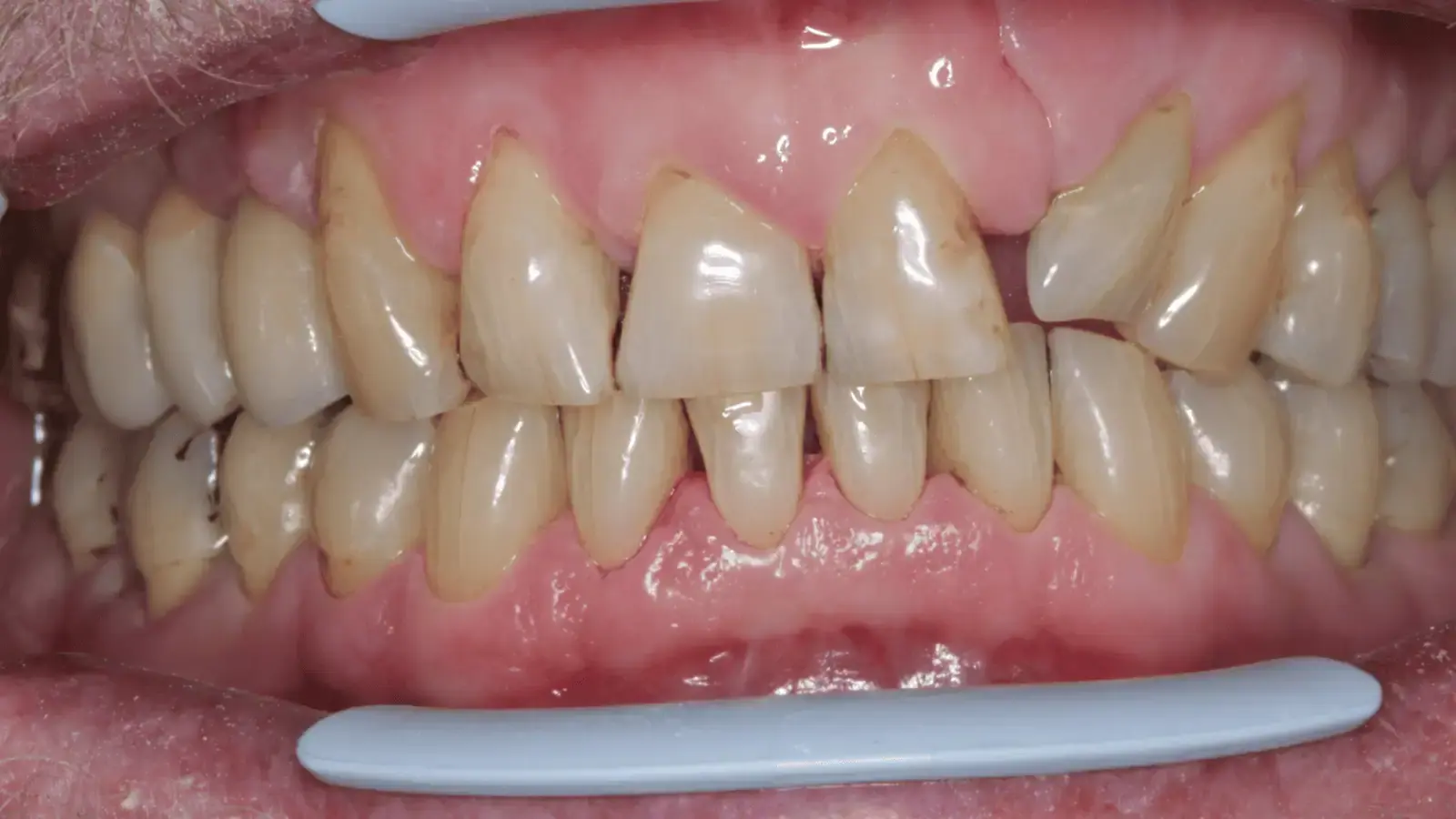 Bright, clean teeth after professional airflow stain removal showing dramatic improvement