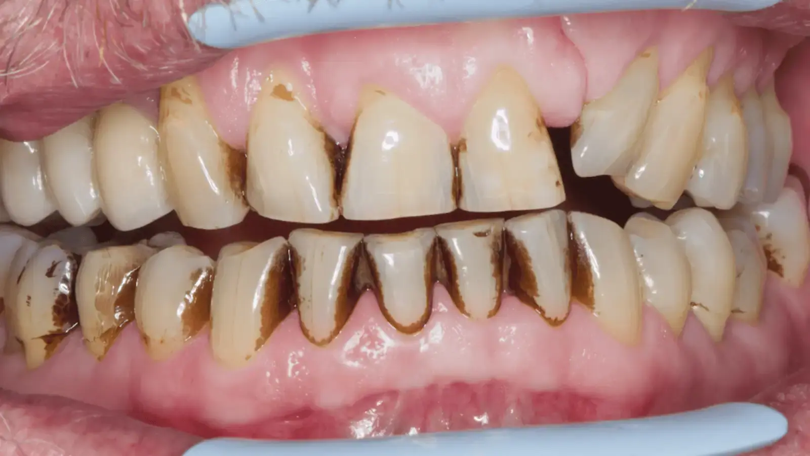 Heavily stained teeth before professional airflow stain removal treatment