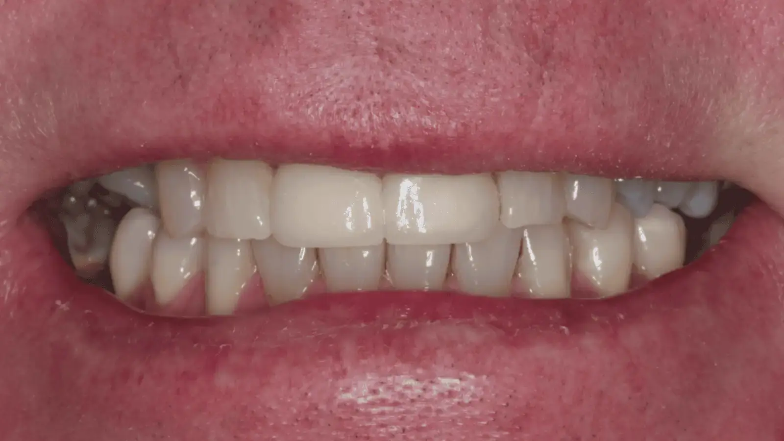 Patient's restored smile with flexible denture and bridge providing natural appearance