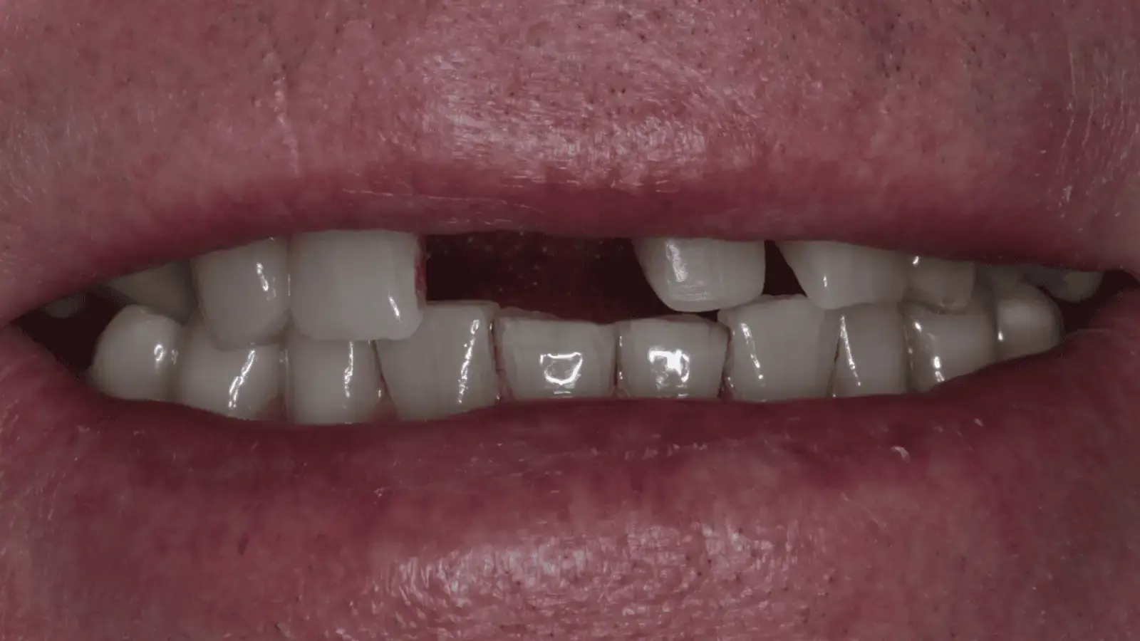 Patient requiring flexible denture and bridge treatment for multiple missing teeth