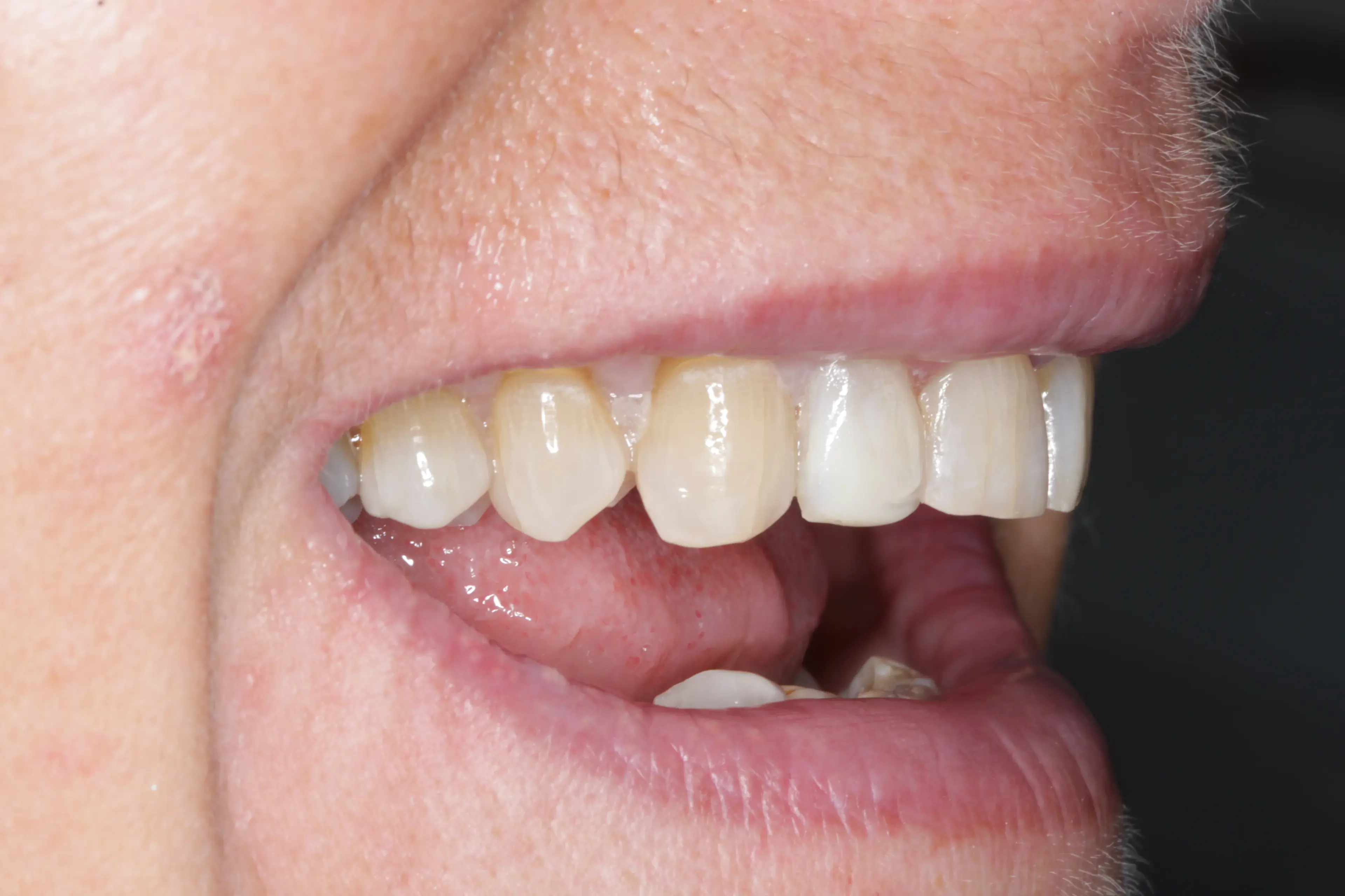 After: Complete restoration with implant-supported teeth