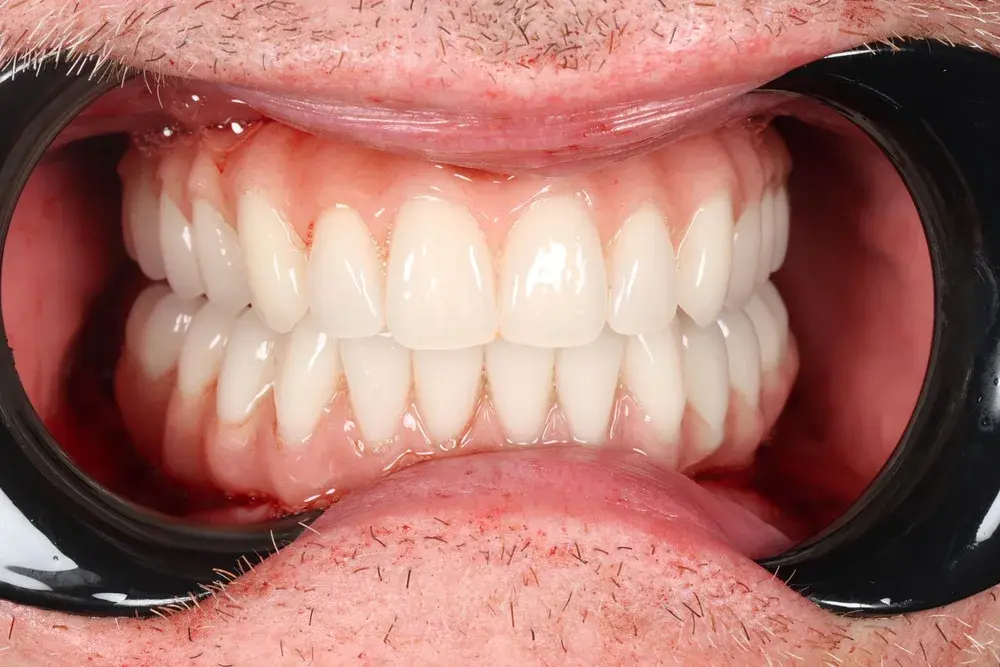 After All-on-4 full-arch implant restoration with a complete set of natural-looking white teeth