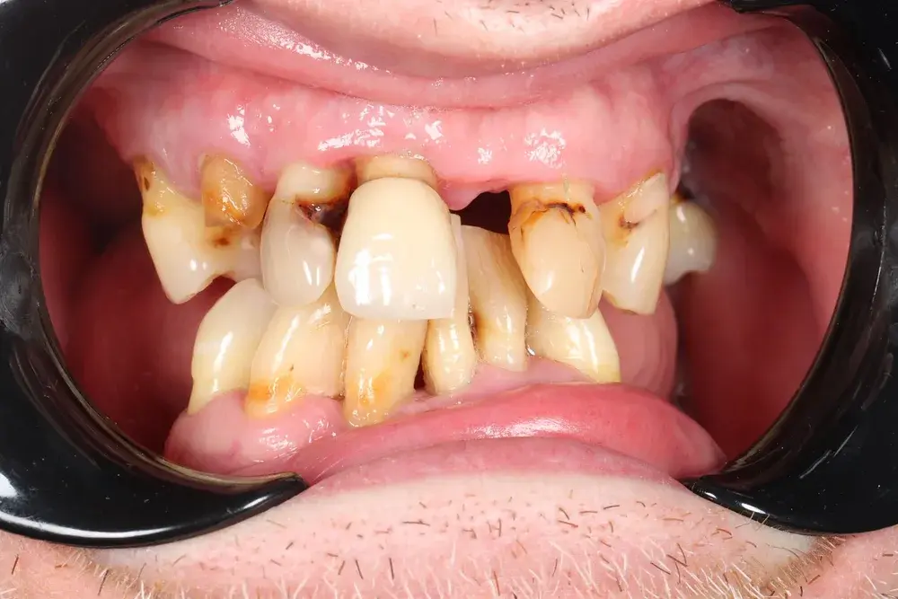 Before All-on-4 implants showing severely worn, decayed and missing teeth
