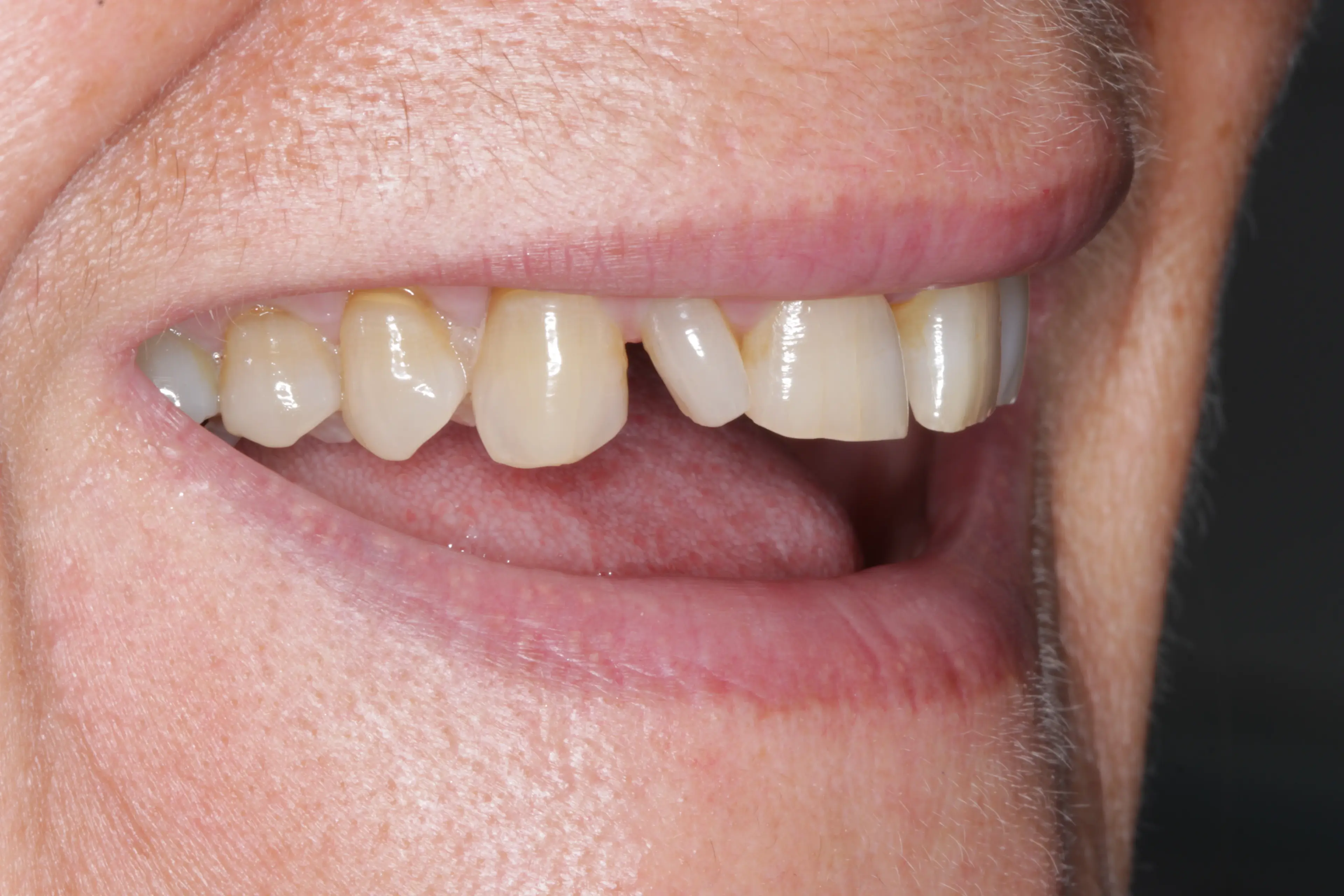 Before: Multiple missing teeth with gaps