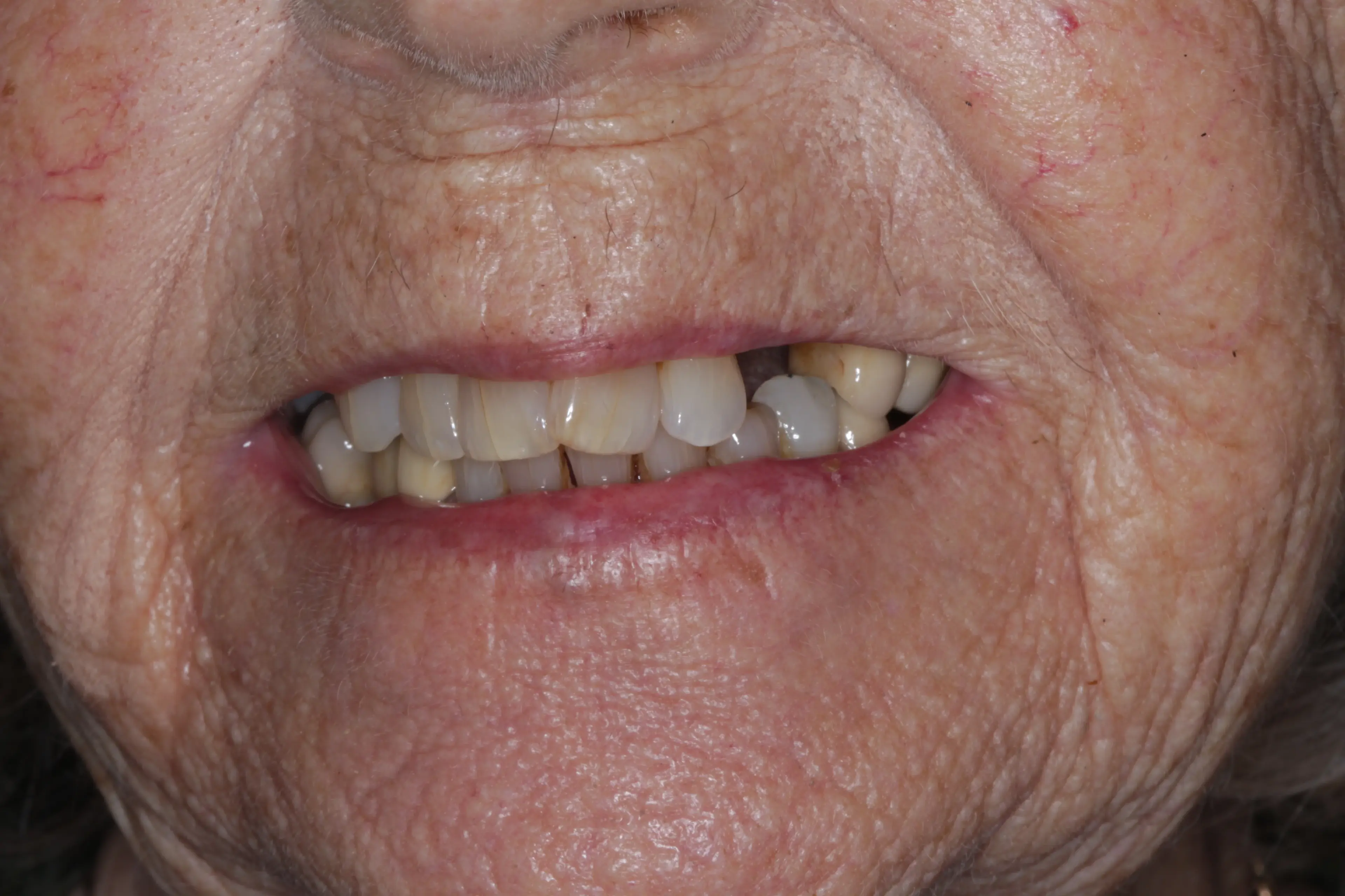 Damaged teeth requiring restorative treatment with visible decay and structural issues