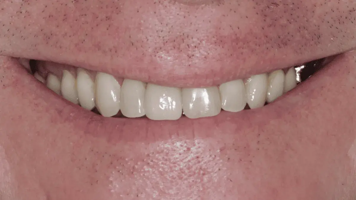 After single dental implant
