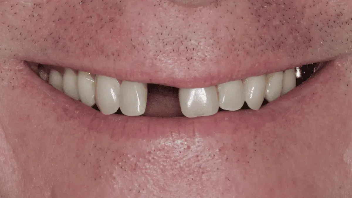 Before single dental implant