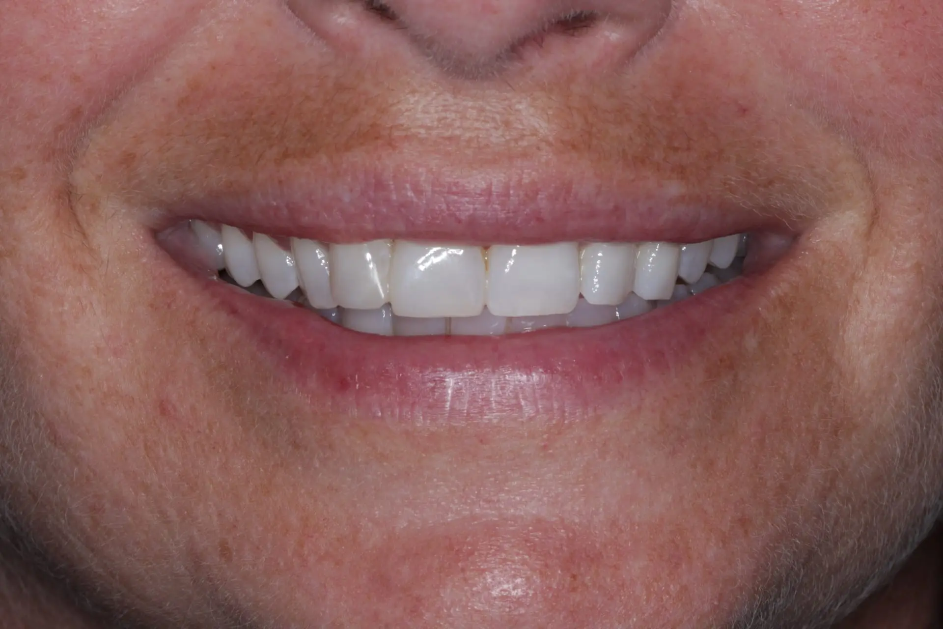 Bride's teeth after professional whitening treatment - dramatically whiter smile perfect for wedding photos