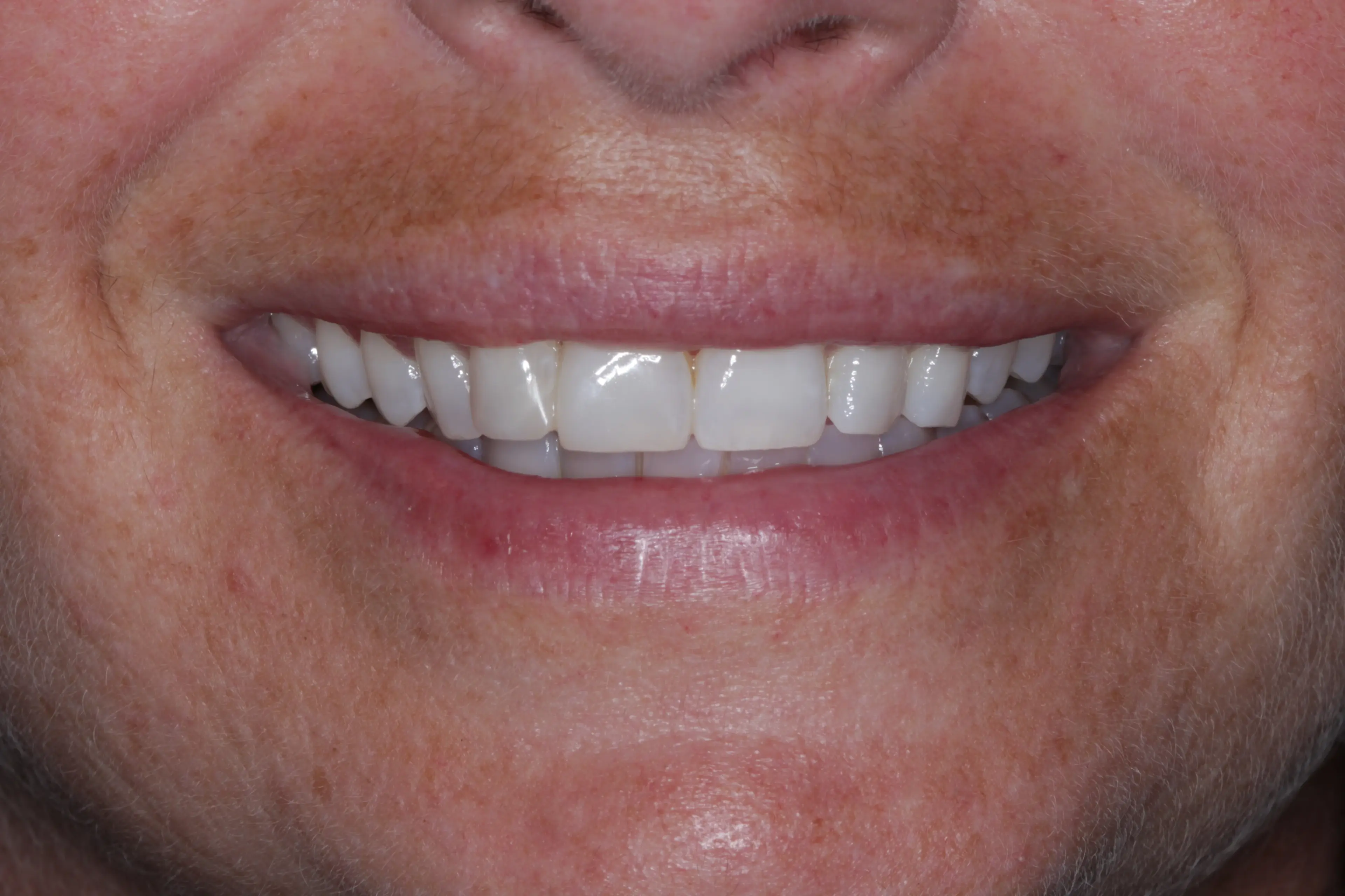 After: Bright, uniform smile with perfect proportions