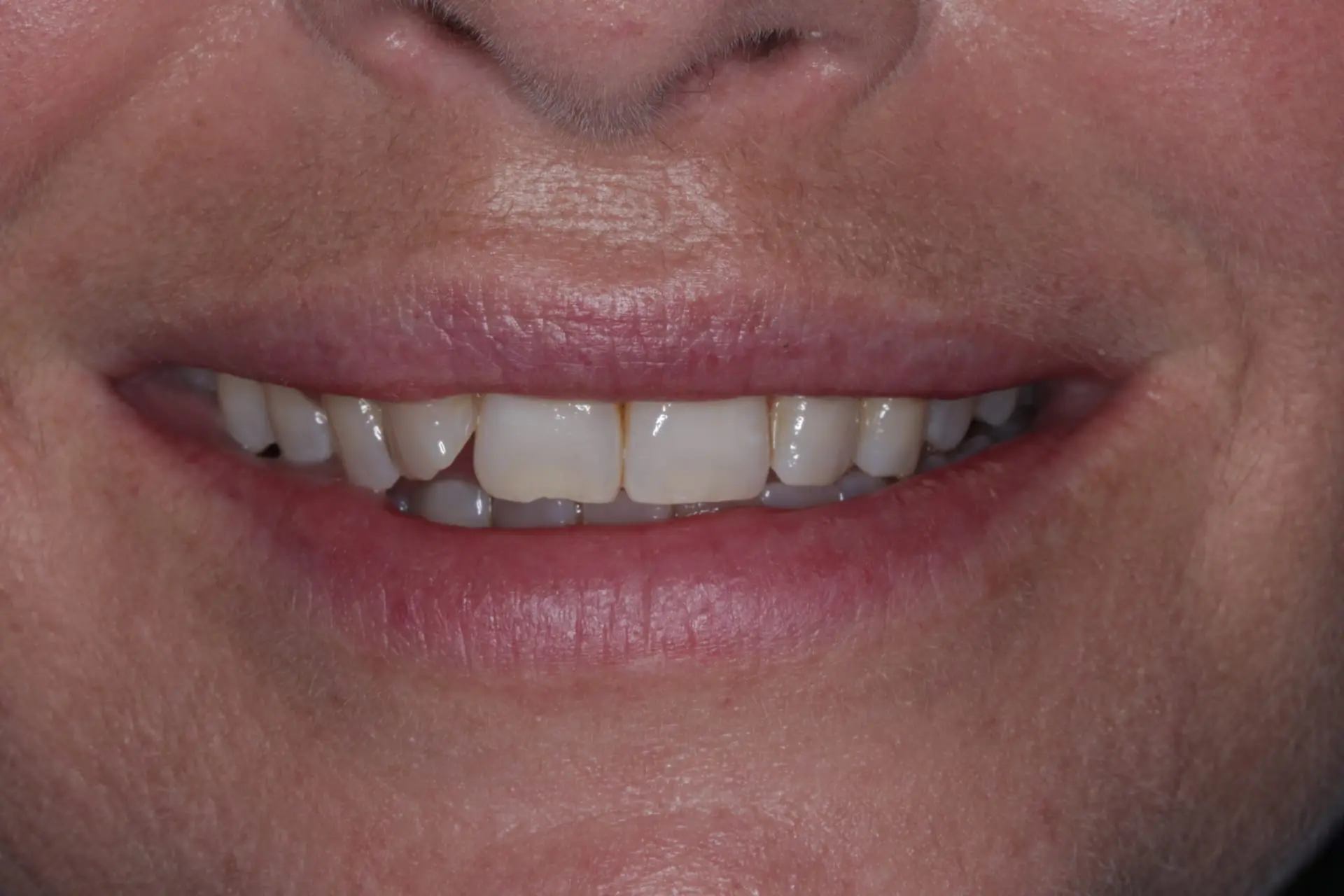 Bride's teeth before professional whitening treatment showing natural discolouration