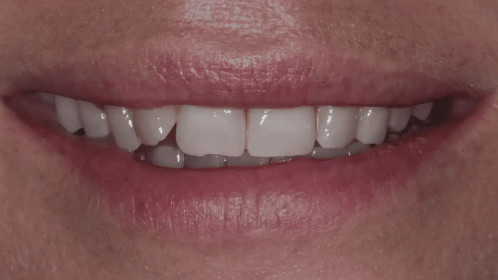Before: Discoloured teeth with irregular edges