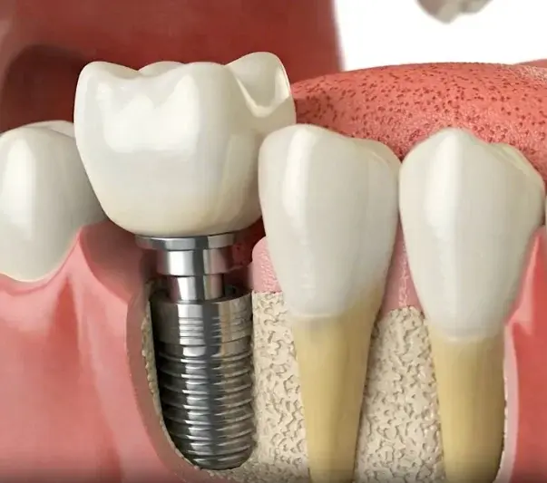 Implant Dentistry background
