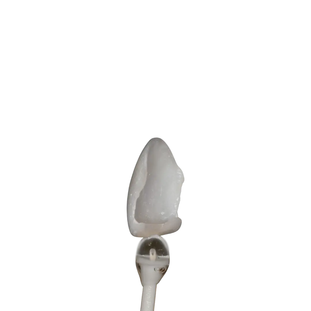 Porcelain Veneers vs Composite Bonding in Nottingham: Which Is Right for You?