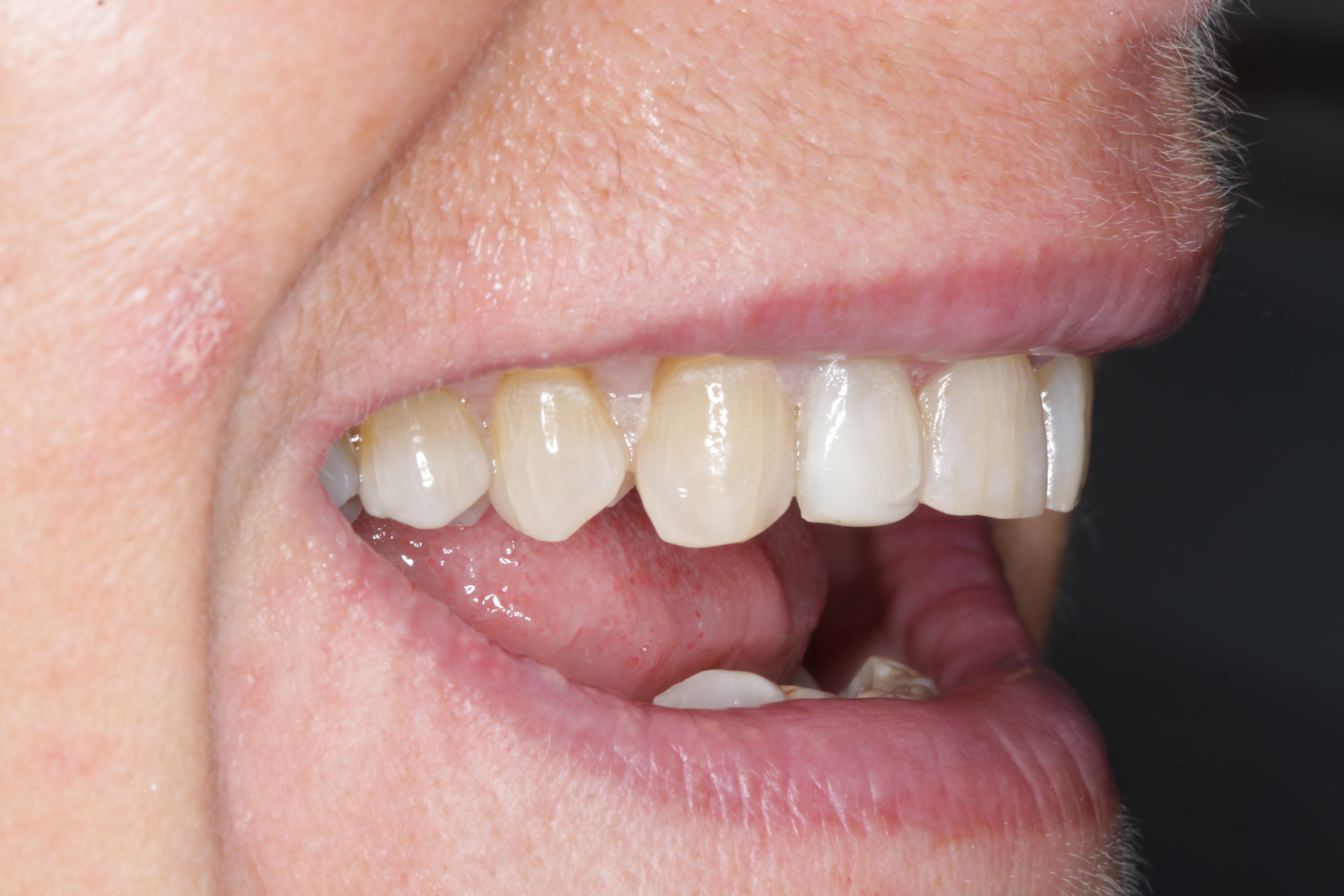 Patient after dental implant treatment with natural-looking replacement tooth perfectly integrated