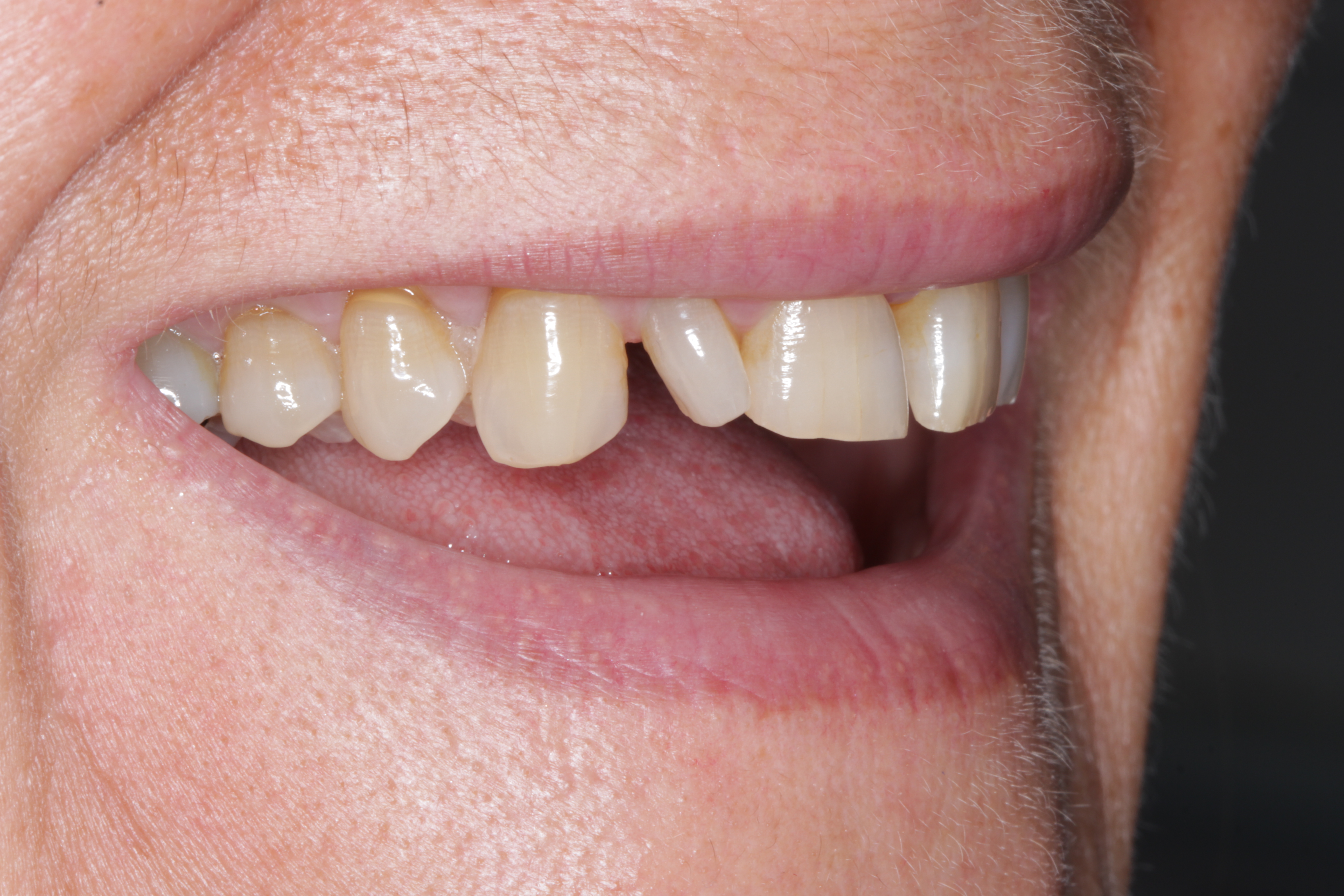 Patient with missing tooth before dental implant treatment showing gap in smile