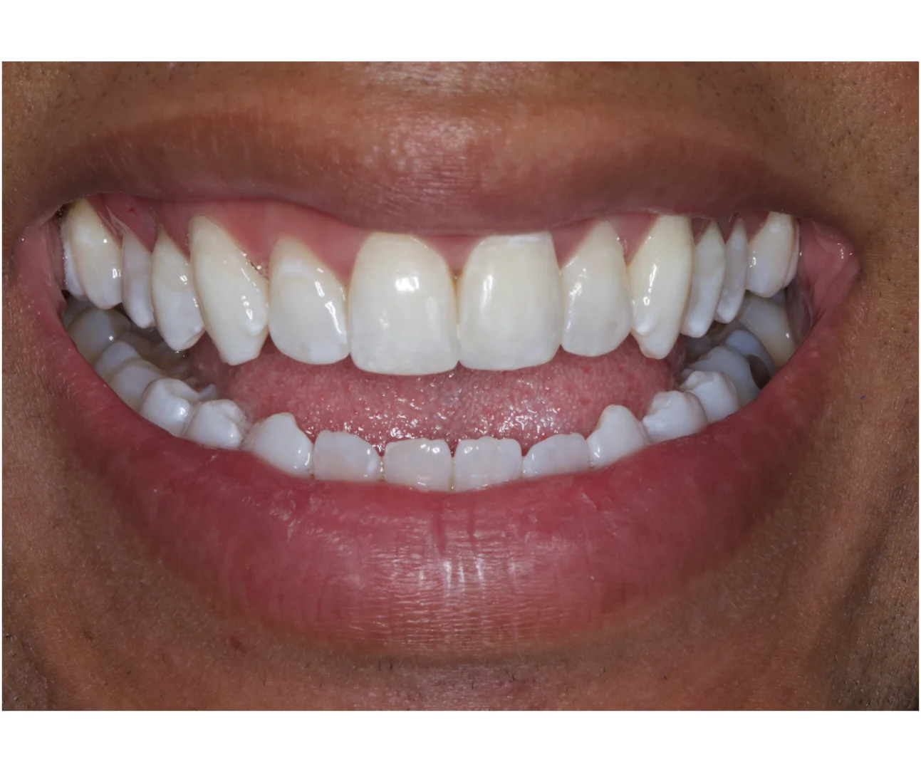 Complete smile makeover transformation result